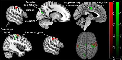 Sex Differences of Periaqueductal Grey Matter Functional Connectivity in Migraine